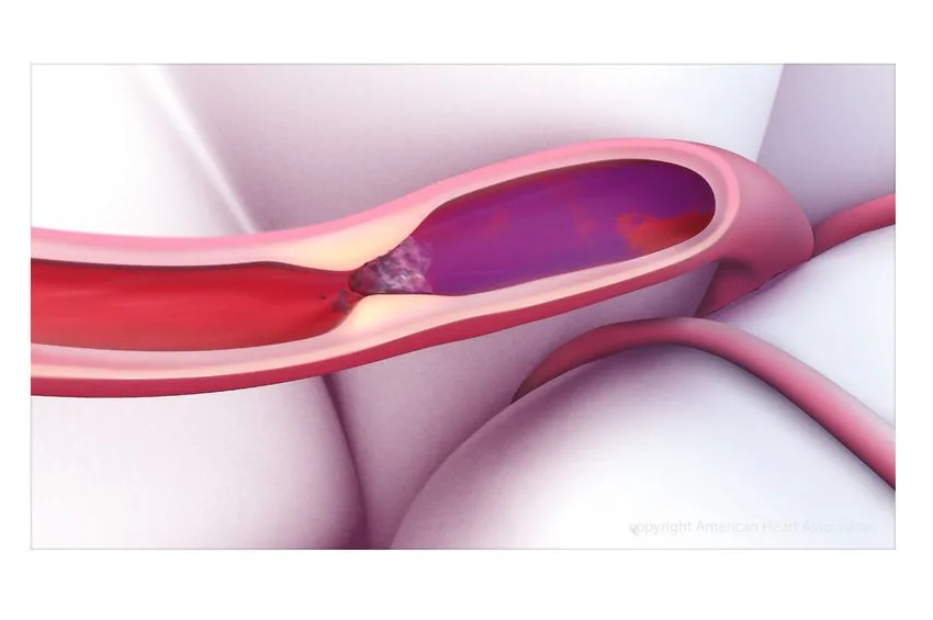 No Boost in Stroke Recovery with Blood Thinners: Study Findings